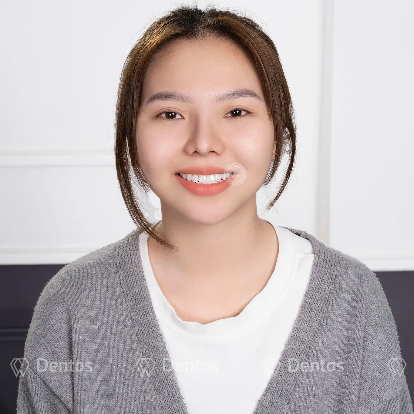 Bọc răng sứ nguyên hàm là phục hình cho toàn bộ hoặc phần lớn các răng trong vùng cười